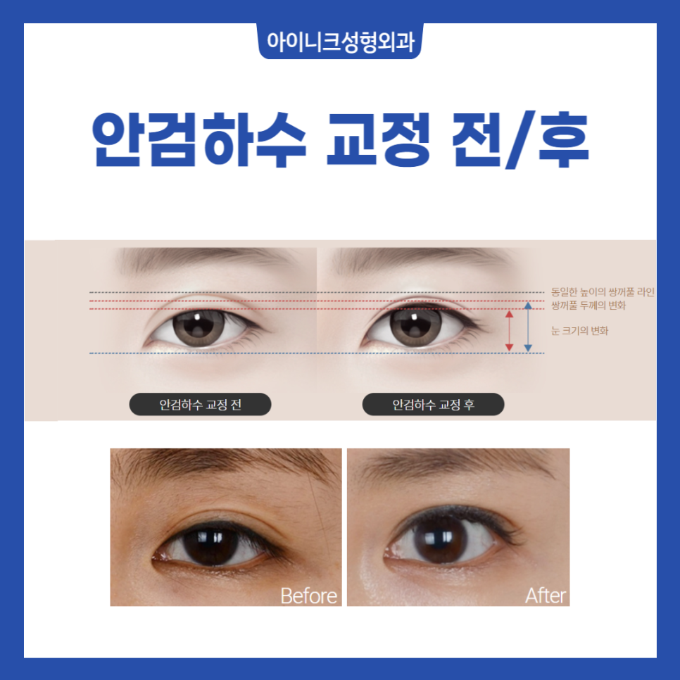 소시지눈재수술 원인부터 파악해야 실패 없어요 관련 이미지 4