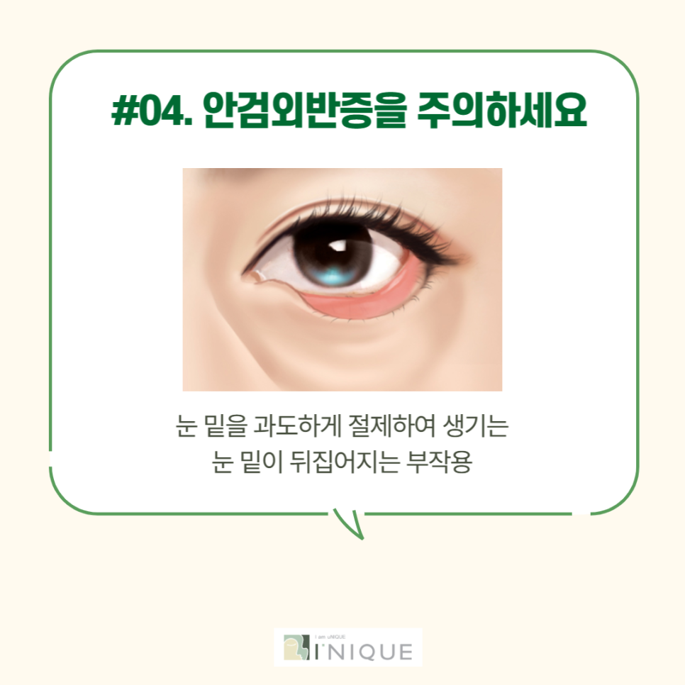 중년눈성형을 통해 다시 젊고 자신있게! 관련 이미지 5