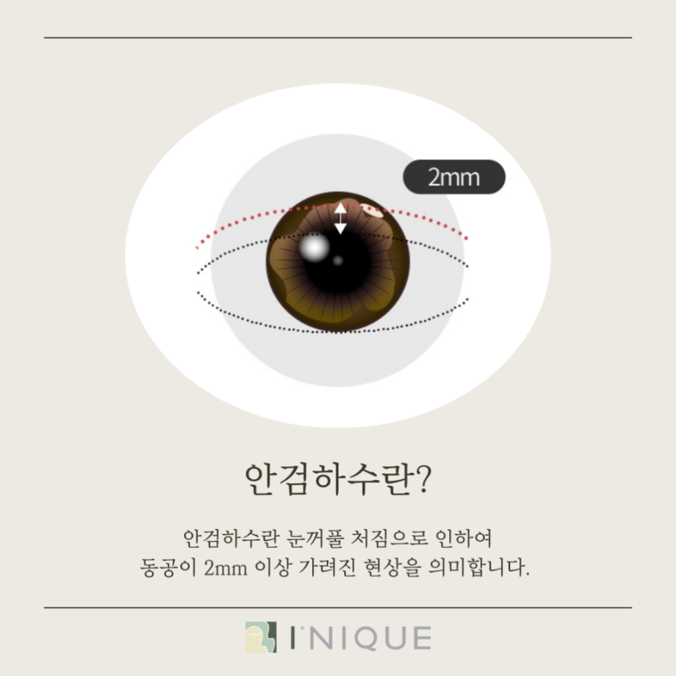 안검하수병원추천, 무엇을 고려해야 할까요? 관련 이미지 2