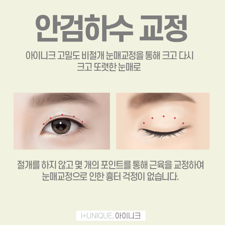 눈재수술추천을 알아보고 있다면 바로 여기 아이니크성형외과 관련 이미지 5