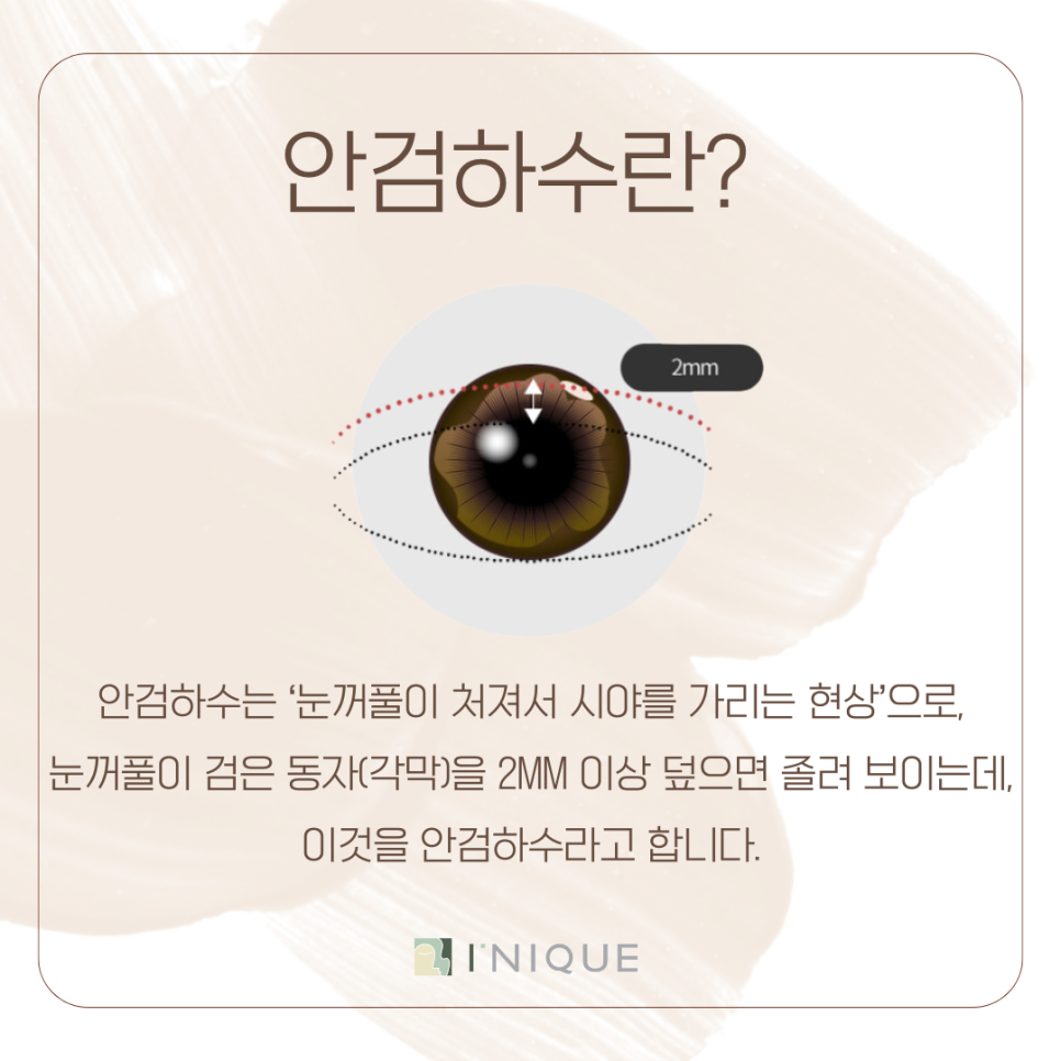 남성눈성형 느끼하지 않은 깔끔한 인상으로 관련 이미지 4