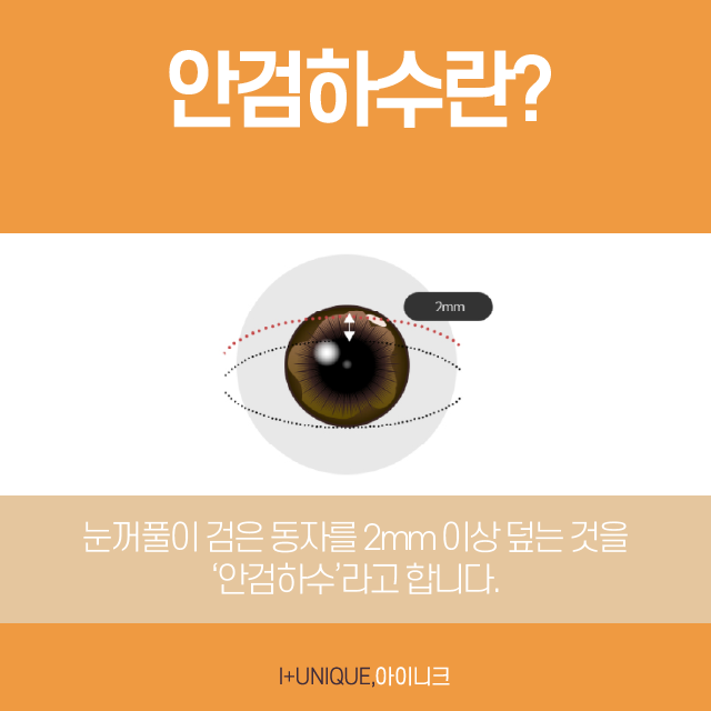 비절개눈매교정, 성공하는 중요한 포인트! 관련 이미지 3