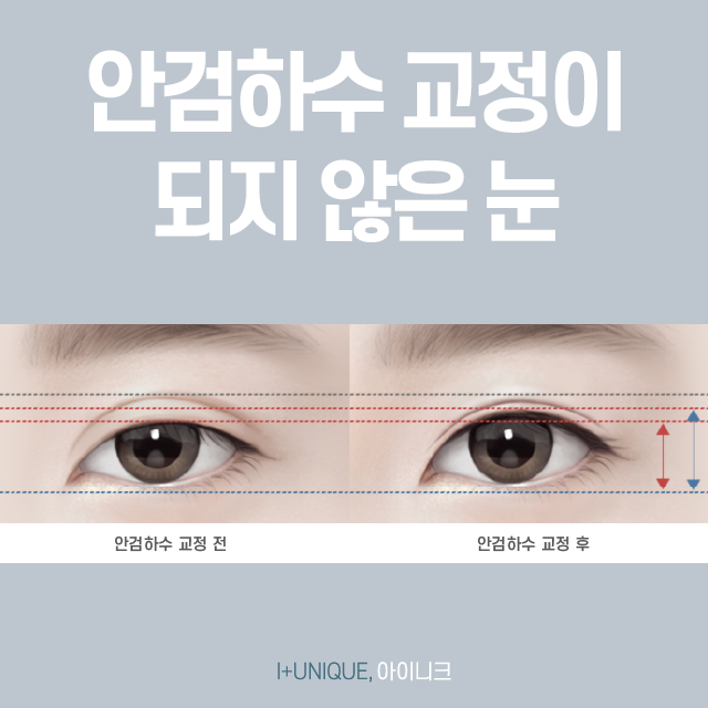 실패 걱정은 이제 그만! 눈성형재수술, 한 번에 끝내자!! 관련 이미지 4