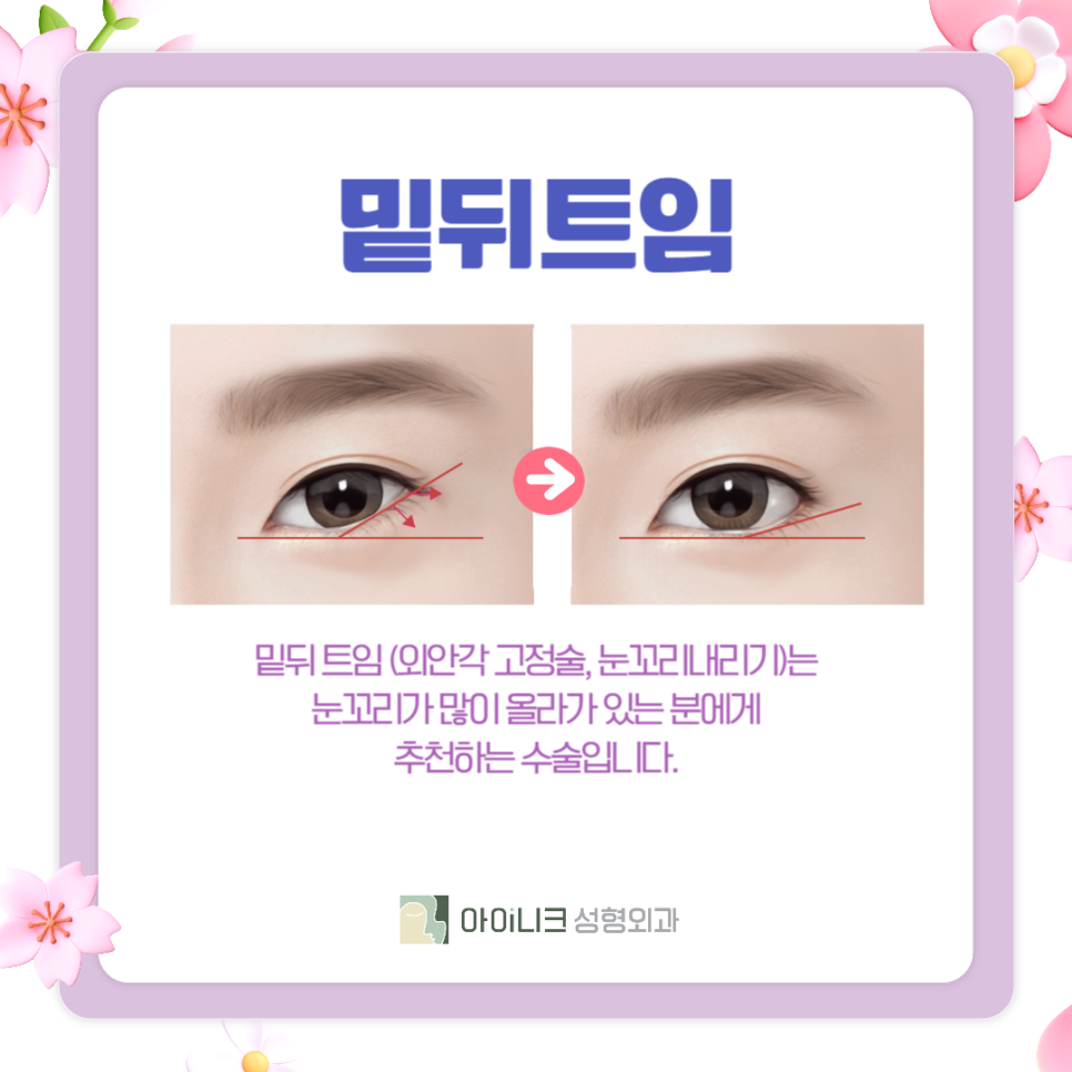 The Best Place for Women’s Eye Surgery Is Where I Had It Done image 5