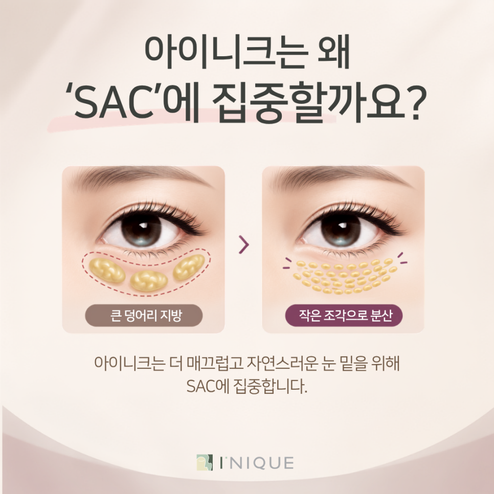 눈밑에다크서클, 눈밑지방이 원인일 수도 있을까요? 관련 이미지 5