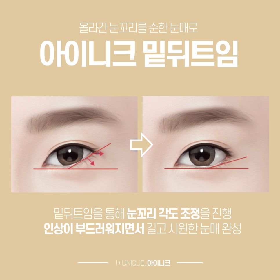 서울뒤트임 잘하는 곳을 찾고 있다면 아이니크성형외과 관련 이미지 4