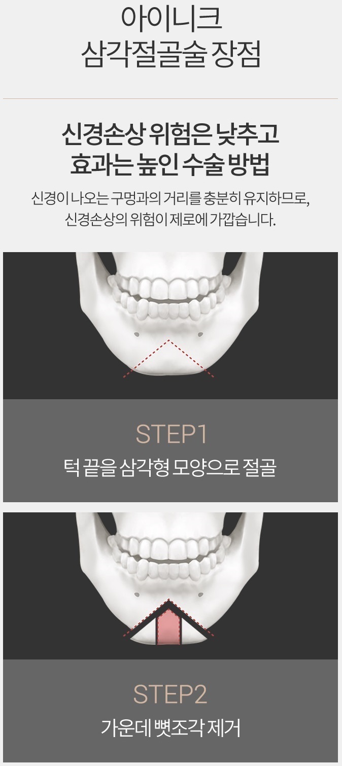 턱끝축소술비용 합리적인 선택, 아이니크! 관련 이미지 3