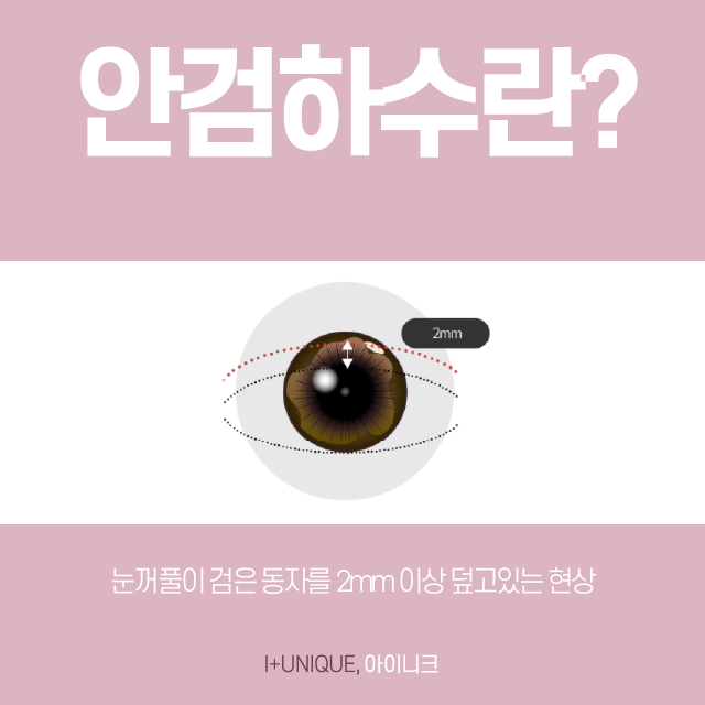 Learn About Incision and Non-Incision Ptosis Correction Without Side Effects image 2