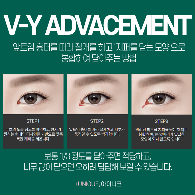 답답해 보이는 눈, 앞트임복원술이 답! 관련 이미지 4