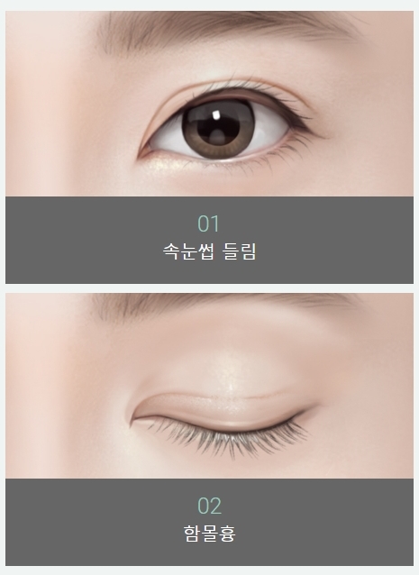쌍커플재수술비용 원인별 맞춤 솔루션 제공! 관련 이미지 9