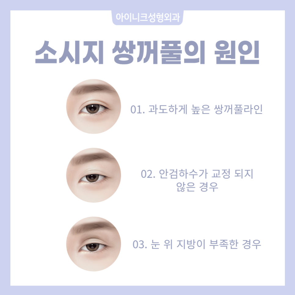 소세지눈재수술로 자연스러움을 되찾는 방법 관련 이미지 2
