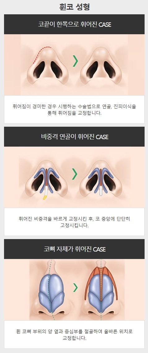 메부리코수술전후 매력적인 라인과 부드러운 인상으로! 관련 이미지 4