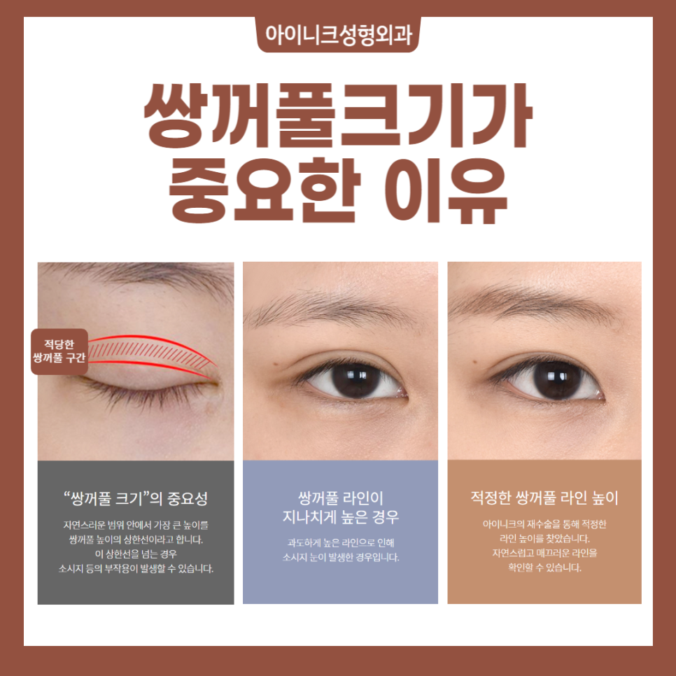 자연스러운눈성형 원한다면 미리 알아야 할 사실 관련 이미지 4