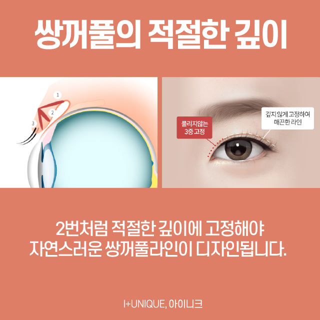 여자눈성형 가장 중요한 포인트는 이것 관련 이미지 4