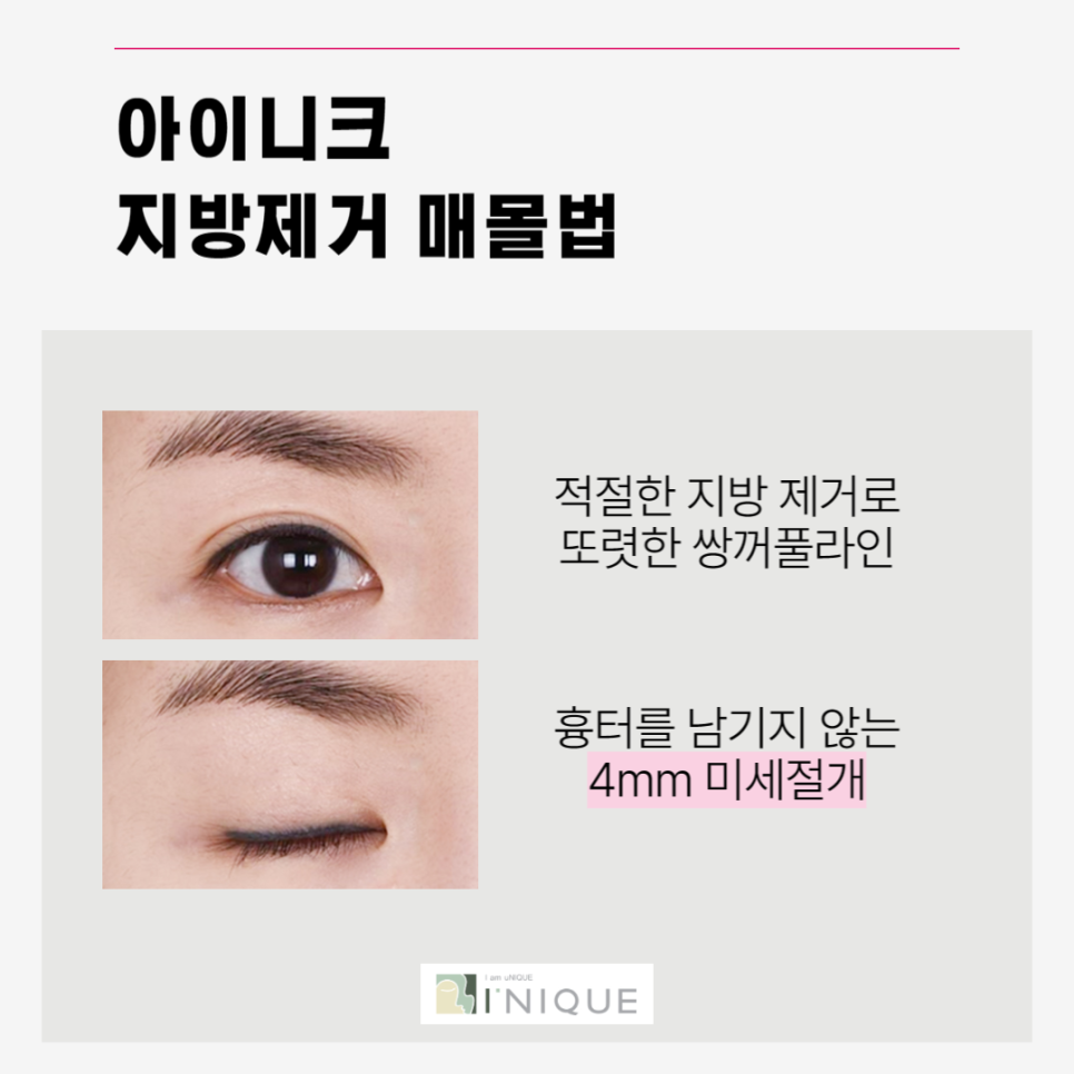Types of Double Eyelid Surgery: Which Method Is Right for Me? image 5