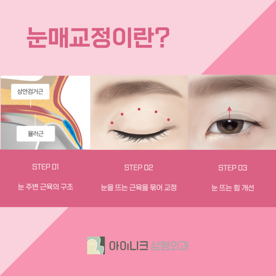 압구정눈성형외과 눈매교정으로 안검하수 개선하기 관련 이미지 5