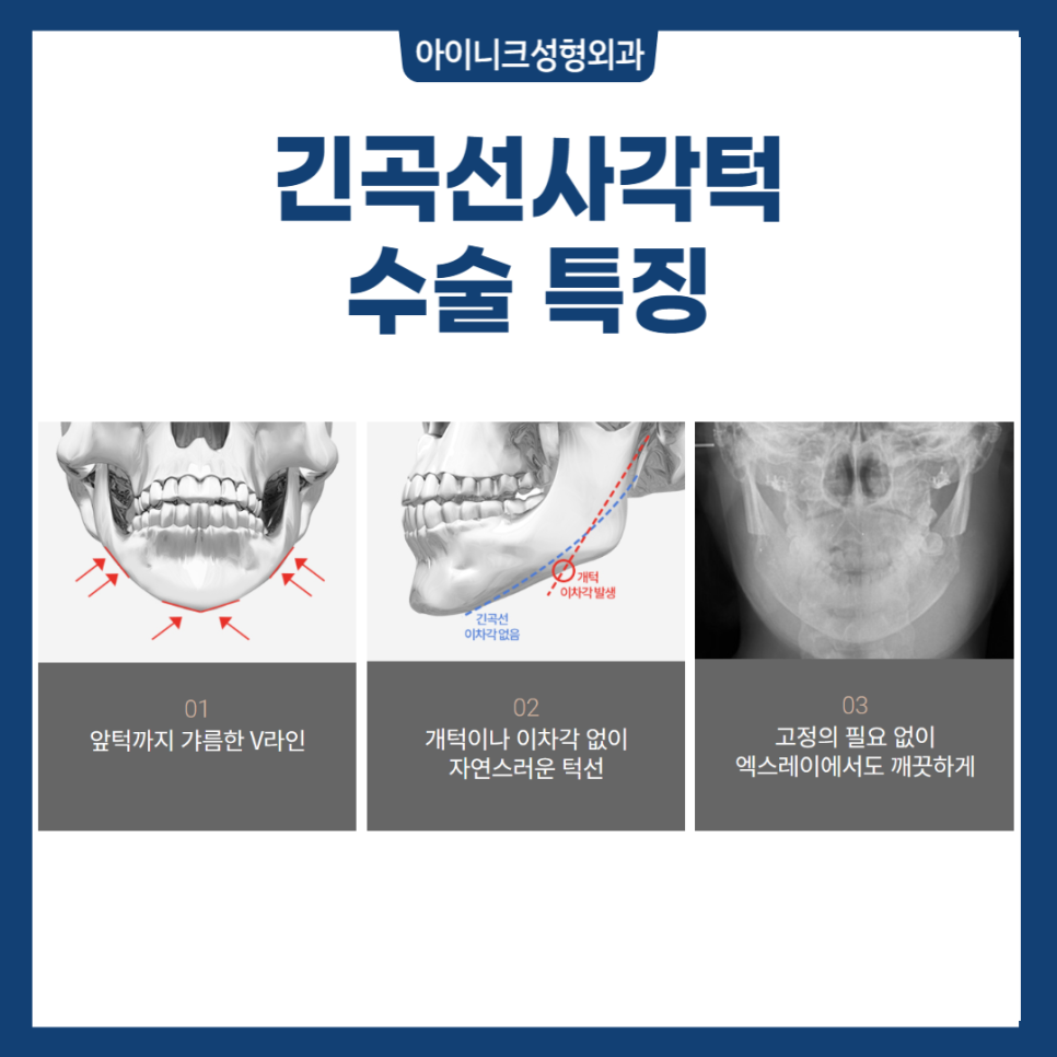 자연스러운 V라인 사각턱성형 관련 이미지 7