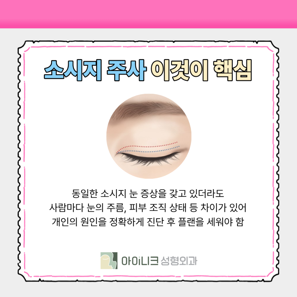 압구정 눈성형외과 소시지 주사로 바쁜 사람도 OK 관련 이미지 4