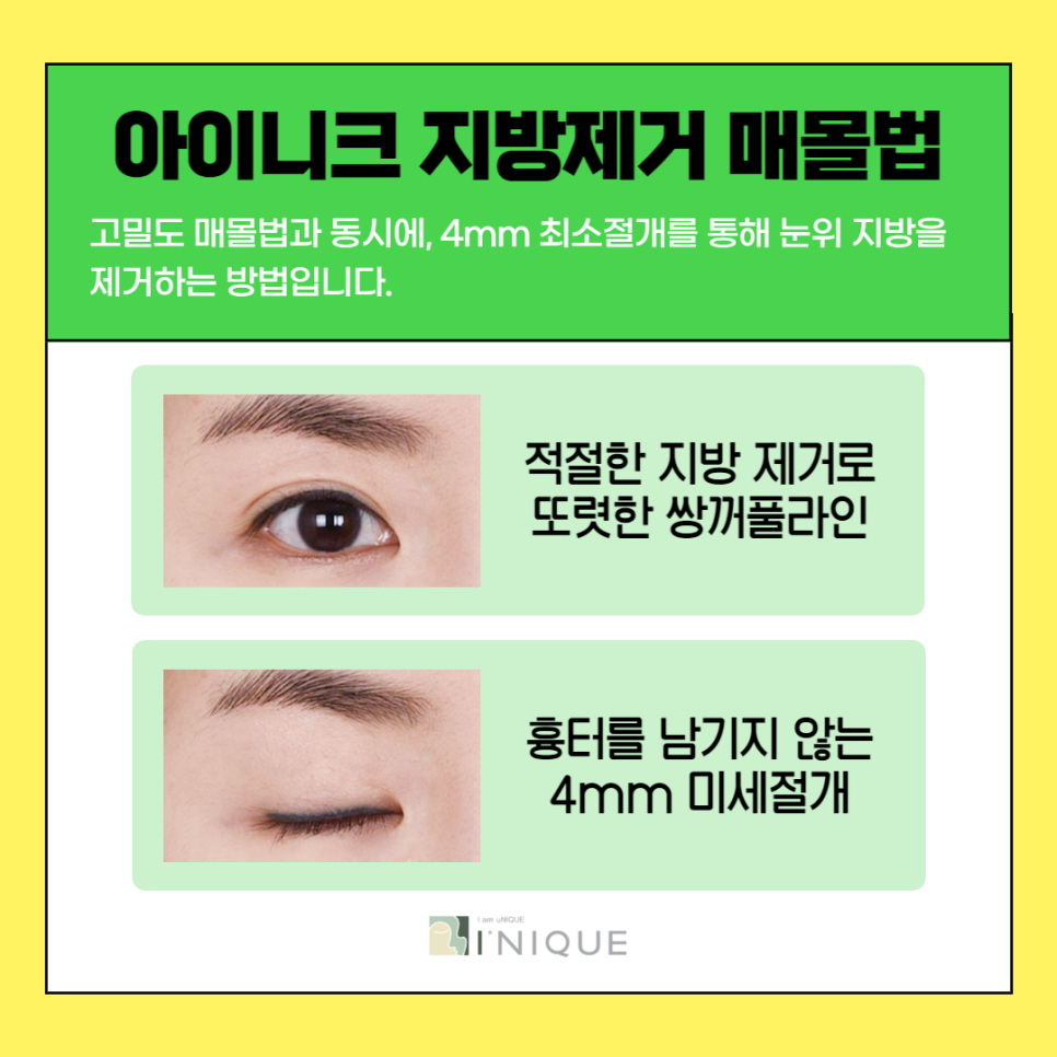 쌍꺼풀병원, 중요한 건 경험과 노하우! 관련 이미지 6