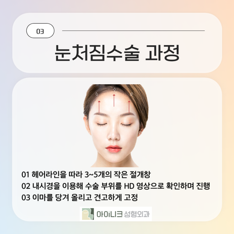 눈처짐수술로 눈에 띄게 달라진 모습 관련 이미지 4