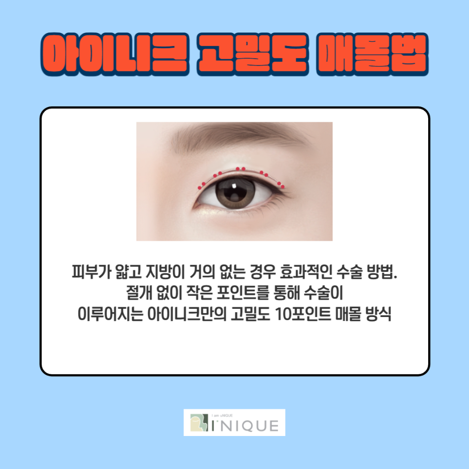 남자눈성형잘하는곳, 자연스럽고 또렷한 눈! 관련 이미지 4