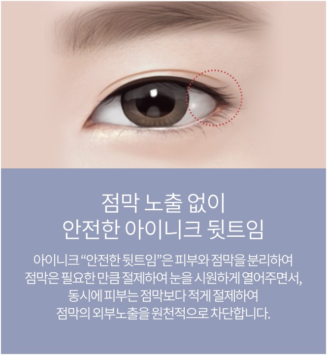 뒤트임복원 아이니크를 찾는 이유 관련 이미지 4