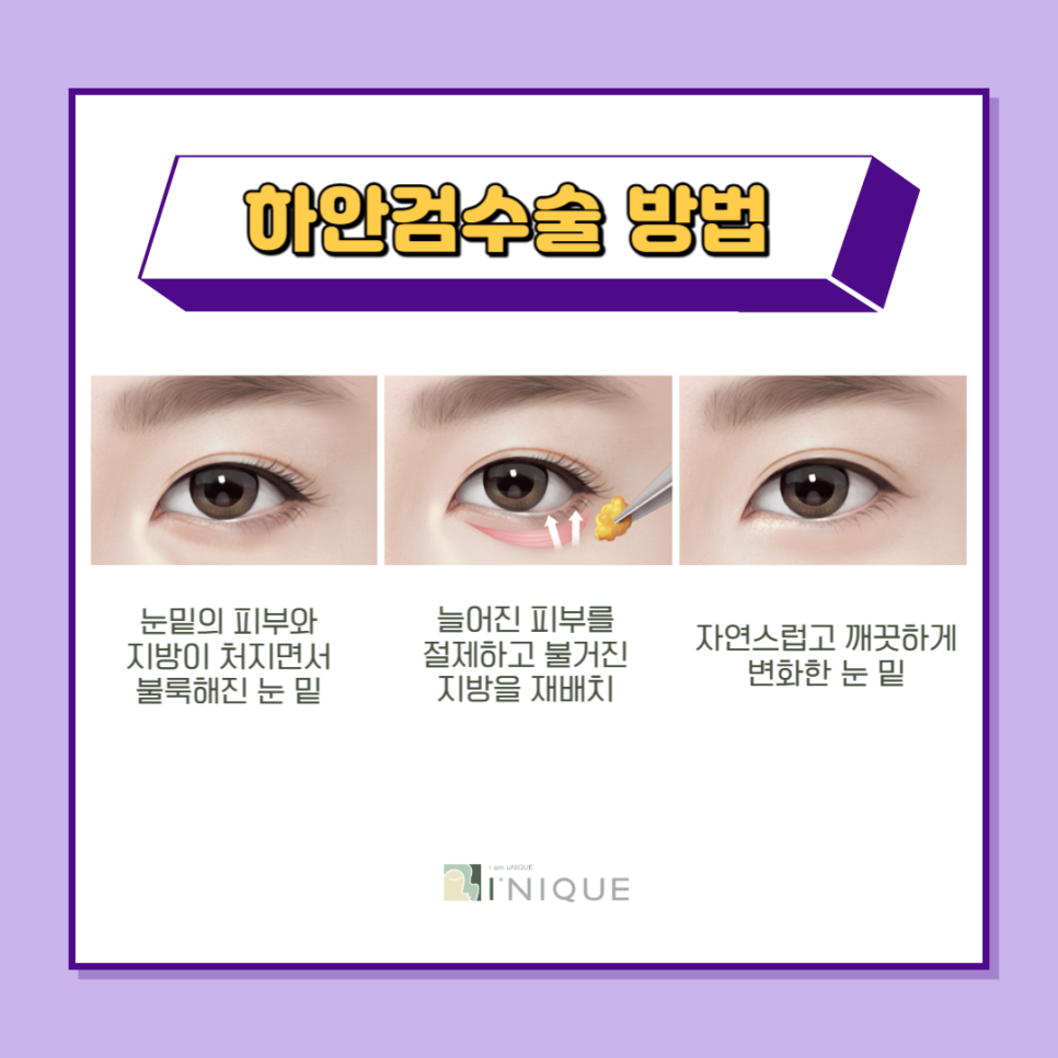 동안눈성형으로 자신감 회복 관련 이미지 4
