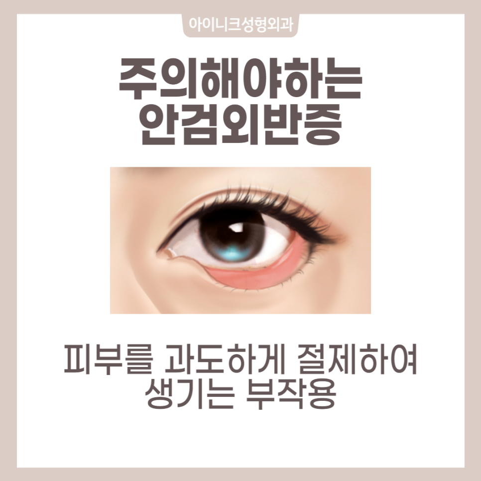 How Can You Get Recommended Midlife Eye Surgery Naturally Without Side Effects? image 5