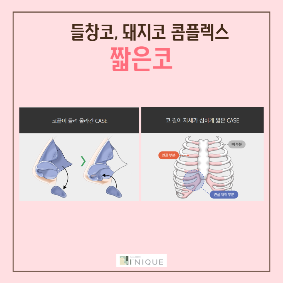 여자코수술, 나에게 맞는 디자인으로! 관련 이미지 4