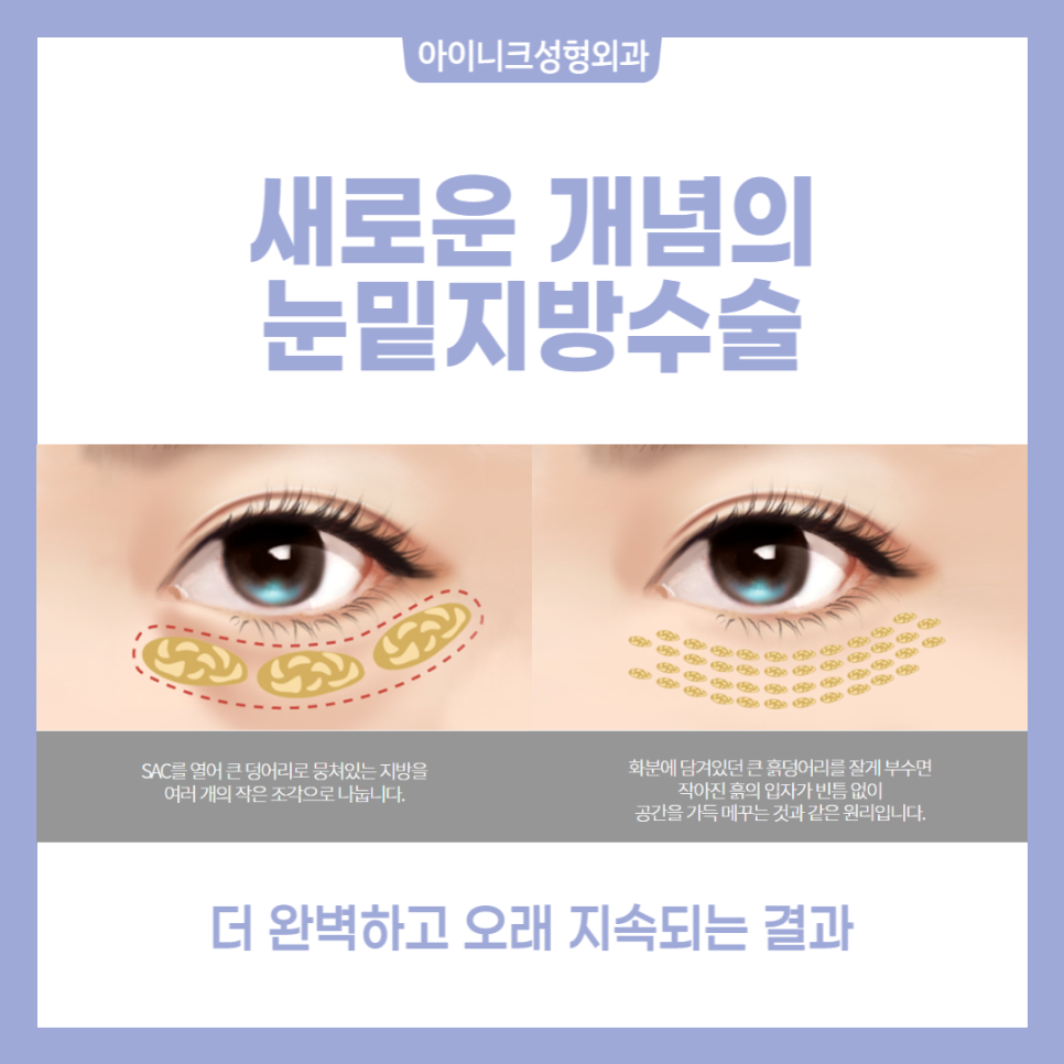 압구정역눈밑수술 걱정 말고 자연스럽게 관련 이미지 3