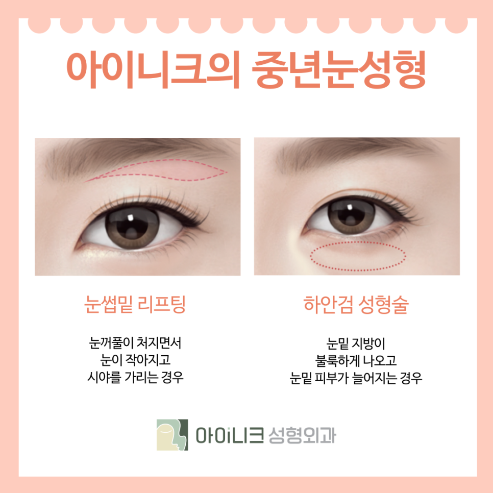 How to Turn Back Time with Eyelid Revision Surgery in Seoul for Middle-Aged Patients image 4