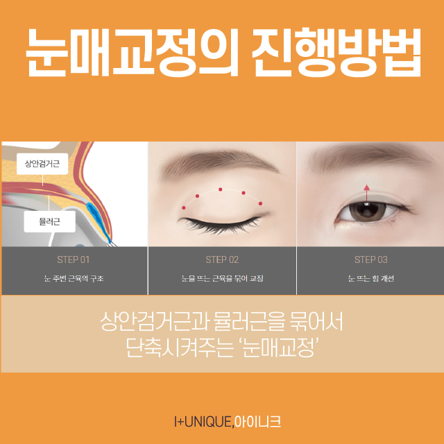 비절개눈매교정, 성공하는 중요한 포인트! 관련 이미지 2