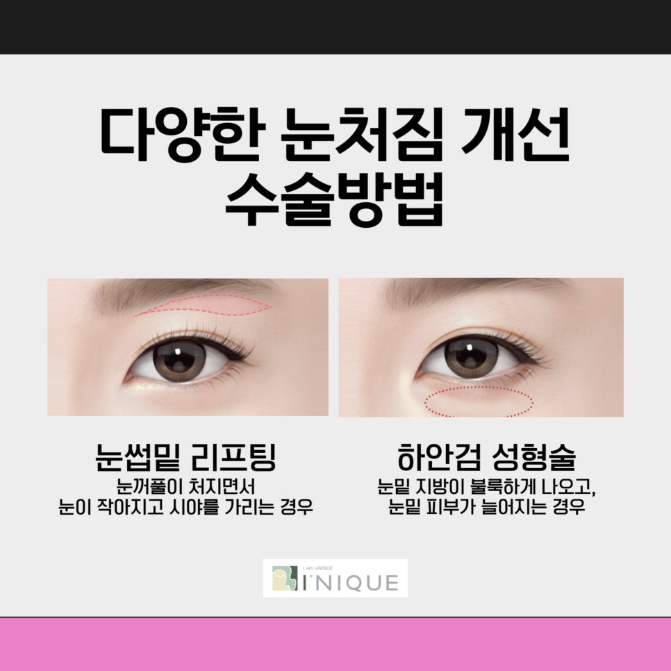 Are You Worried About Sagging Eyelids in Middle Age? image 2