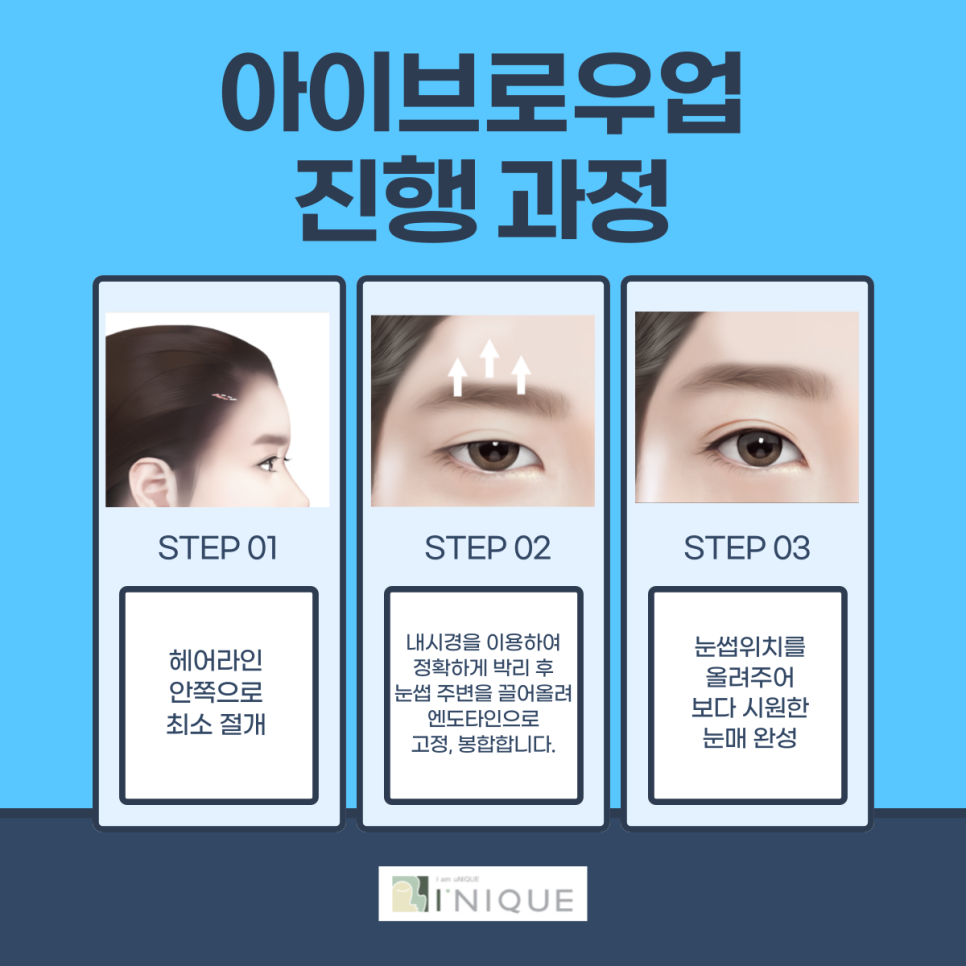 30대눈썹거상으로 깔끔하게 관련 이미지 4