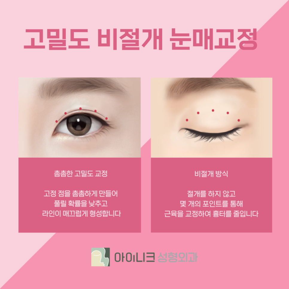 압구정눈성형외과 눈매교정으로 안검하수 개선하기 관련 이미지 6