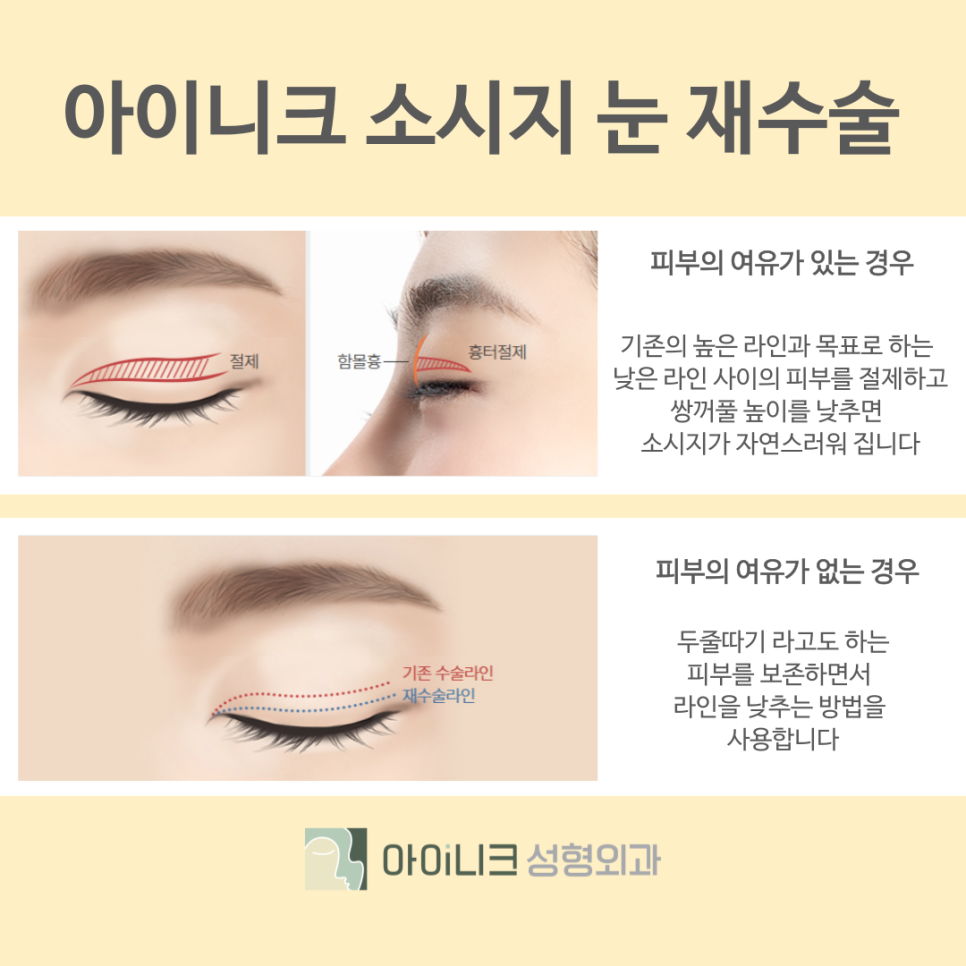 Gangnam Eye Revision Surgery Hospital: If You Want to Restore a Failed Double Eyelid image 7