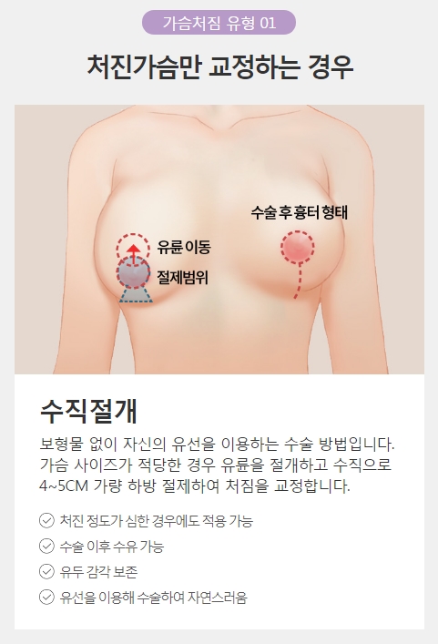 처진가슴수술비용 정확하고 꼼꼼한 맞춤 상담! 아이니크 성형외과! 관련 이미지 3