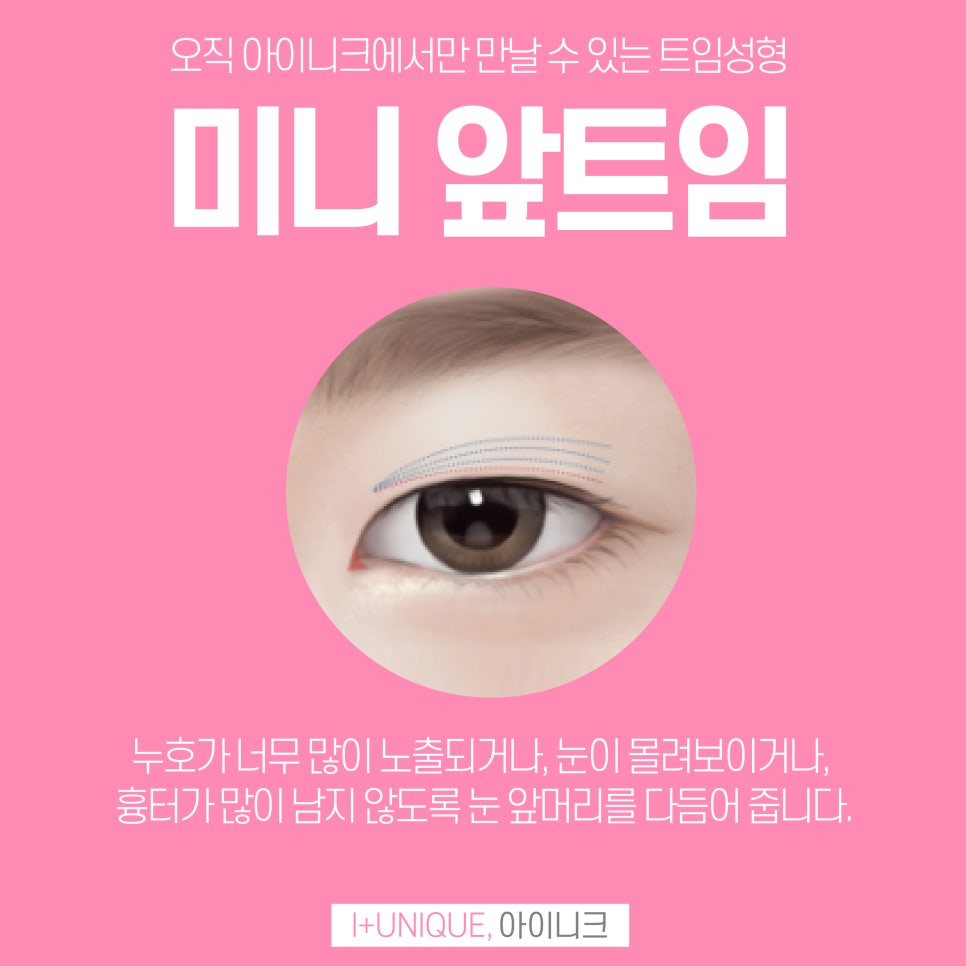 앞트임성형외과 더 이상 힘들게 알아보지 말고 아이니크로! 관련 이미지 5