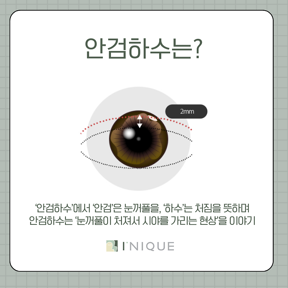강남 눈매교정 이렇게 하면 자연스러워요 관련 이미지 4
