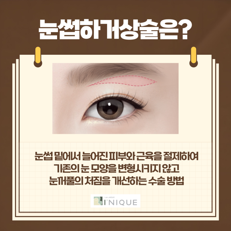 중년남성눈성형도 자신있게! 관련 이미지 5