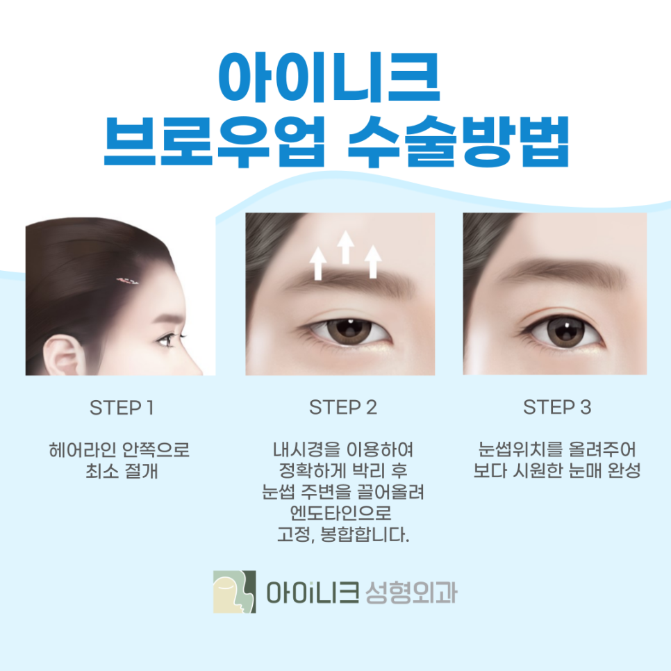 여자눈썹수술 또렷한 인상으로 거듭나기 관련 이미지 4