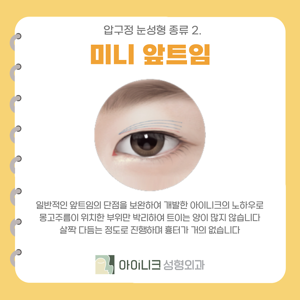 Types of Eye Surgery in Apgujeong: Making the Eye Shape Clearer and Brighter with Canthoplasty image 5