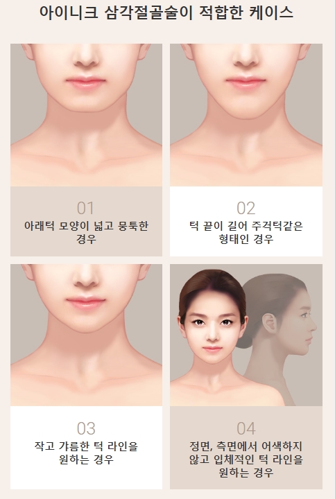턱끝절골술 양악 없이도 완벽한 얼굴라인! 관련 이미지 2
