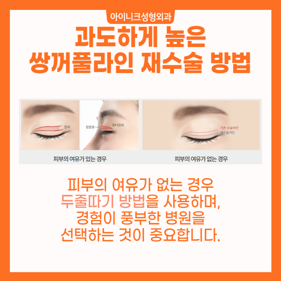 소시지눈해결방법으로 알아보는 확실한 재수술 관련 이미지 3
