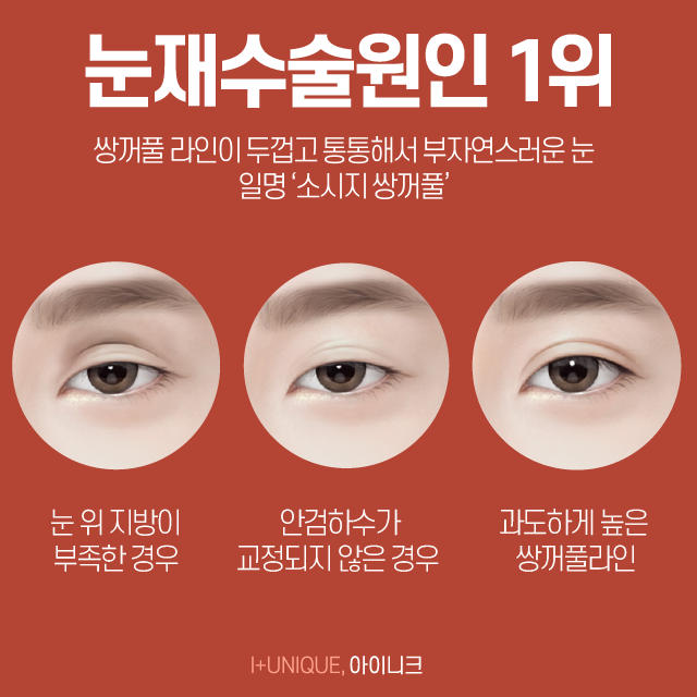 처음만큼 신중해야 하는 쌍꺼풀재수술잘하는병원 고르기 관련 이미지 3