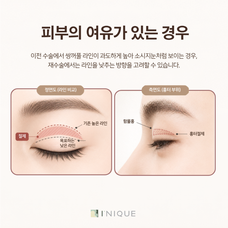 쌍수재수술 후기 찾아보기 전, 라인보다 먼저 확인해야 할 5가지 관련 이미지 5