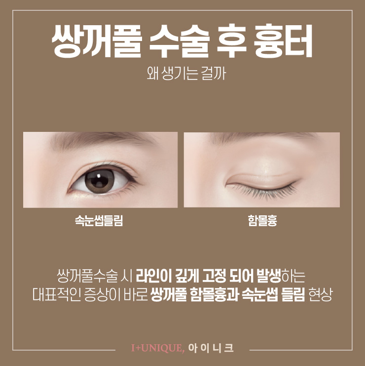 눈재수술을 원한다면 아이니크성형외과에서 확실하게 관련 이미지 2