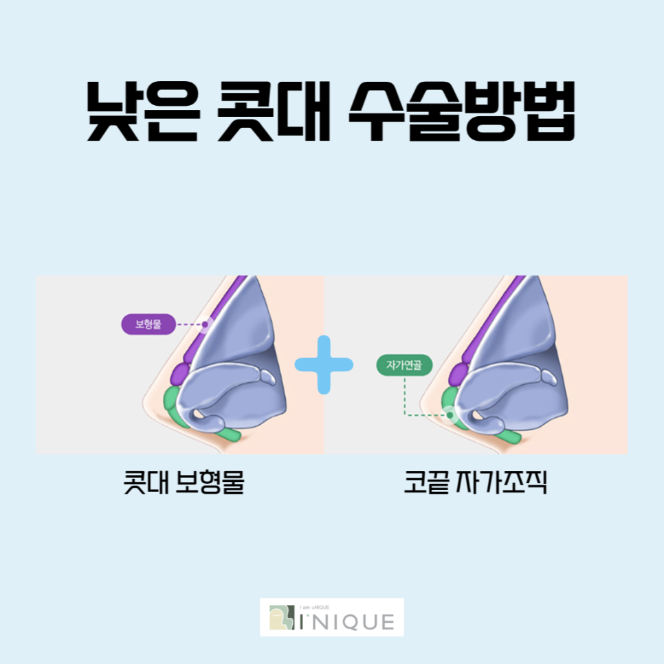 남자코성형후기가 많은 아이니크 관련 이미지 4