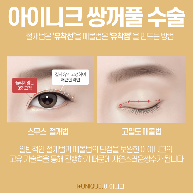 자연스러운쌍수를 원한다면, 병원부터 신중하게 골라야 관련 이미지 5
