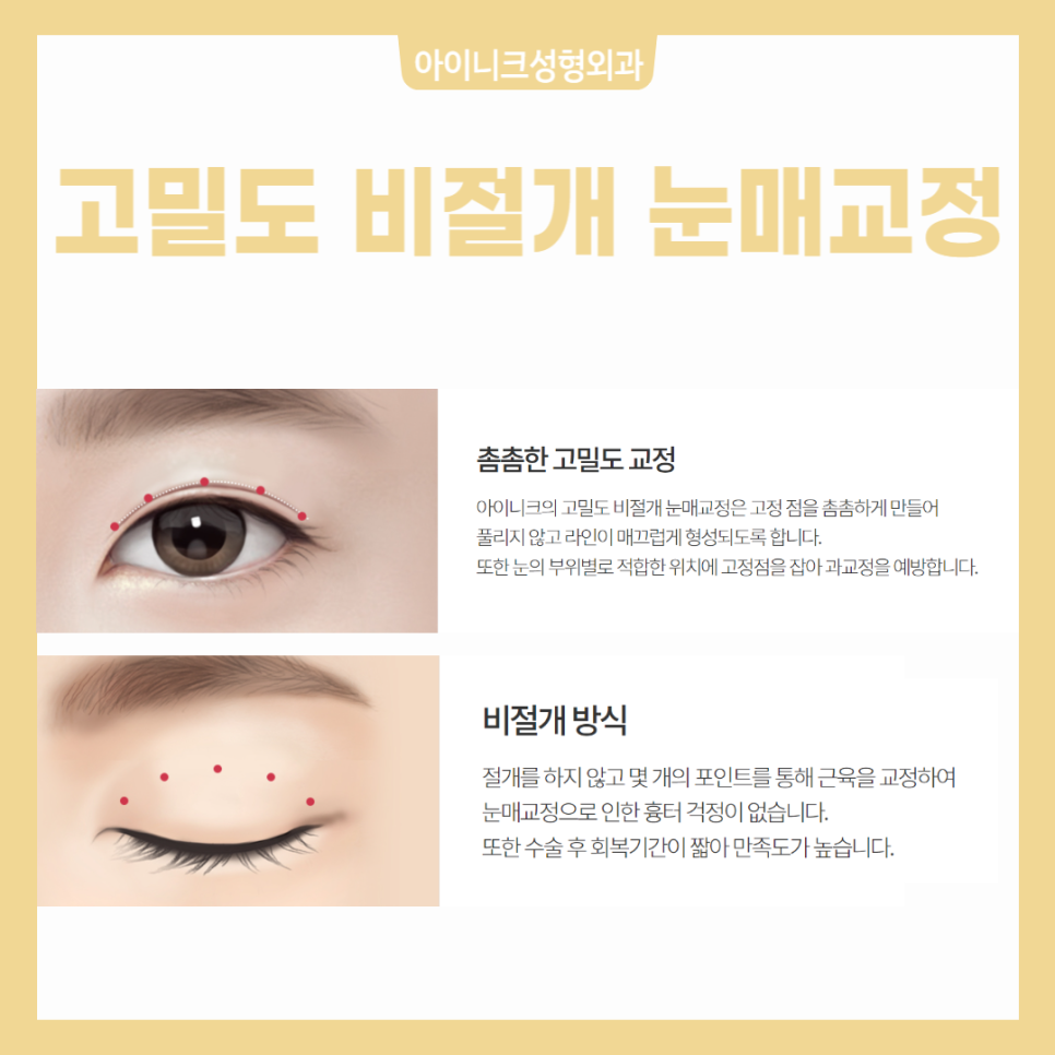 Making Sleepy-Looking Eyes Clear with Ptosis Correction image 5